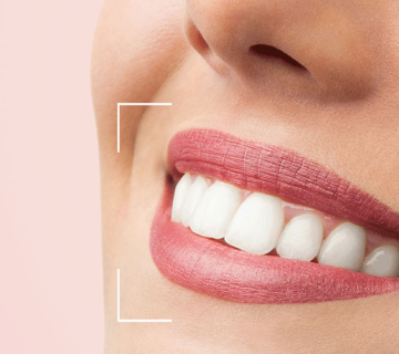 Dental composite for crooked teeth