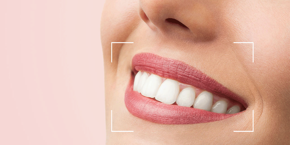 Dental composite for crooked teeth