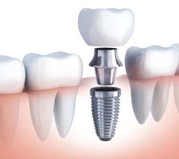 Surgical method and advantages and disadvantages of dental implant bone grafting