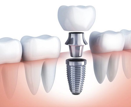 Surgical method and advantages and disadvantages of dental implant bone grafting