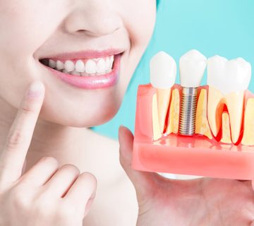 Factors affecting the longevity of dental implants