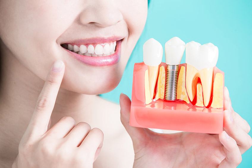 Factors affecting the longevity of dental implants