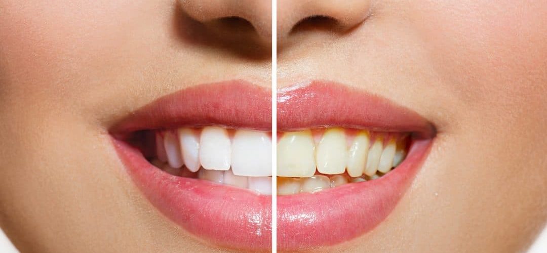 Tooth polishing after composite