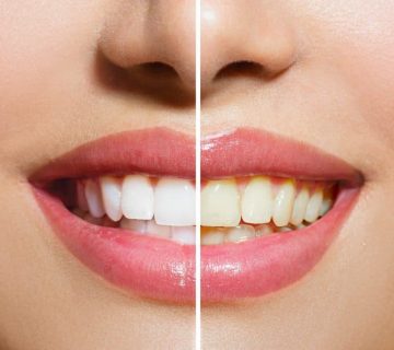 Tooth polishing after composite