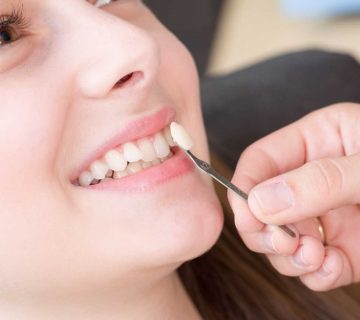 Who can't use dental veneers?