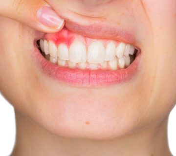 What is a tooth abscess?