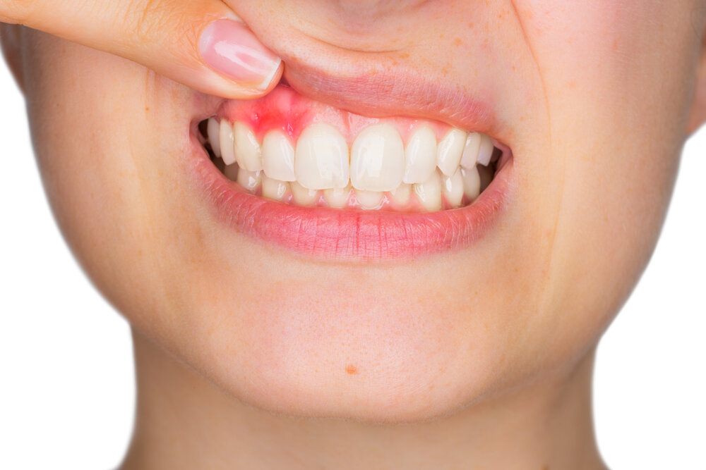 What is a tooth abscess?