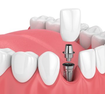 Dental implant is the best way to replace a fallen tooth
