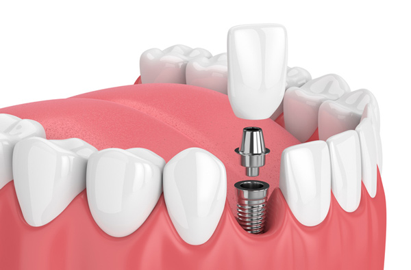 Dental implant is the best way to replace a fallen tooth