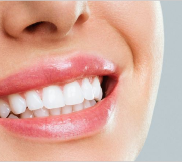 Bleaching or laminate?