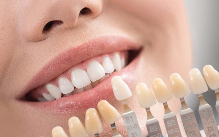 Full description of dental composite and its types