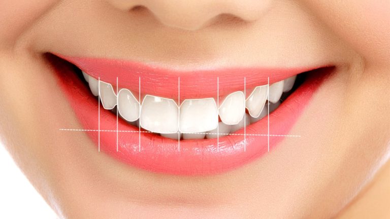 Modifying the smile design (Hollywood smile)
