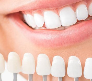 What people can not install composite veneer?