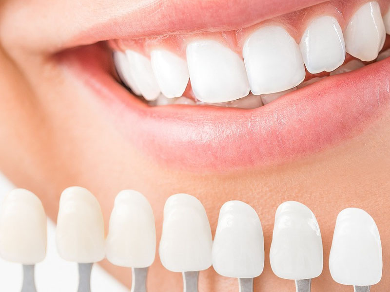 What people can not install composite veneer?