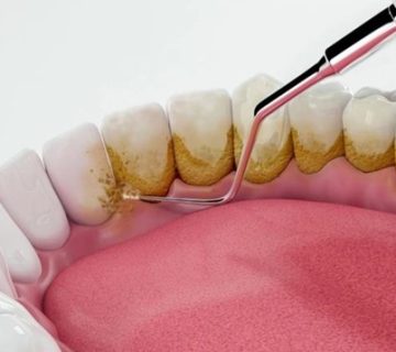 Scaling of composite teeth: Does the composite become white with scaling?
