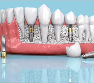 The most important advantages of dental implants