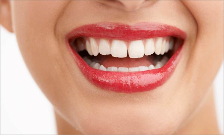 Lamination of spaced teeth