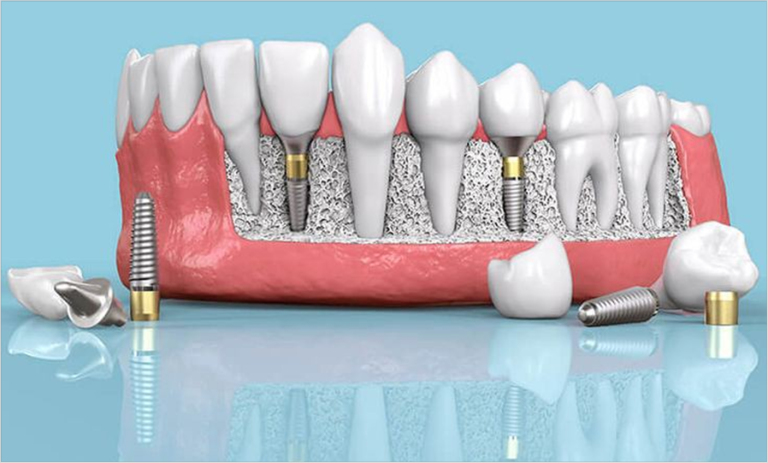 The most important advantages of dental implants