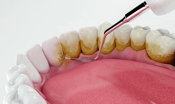 Scaling of composite teeth: Does the composite become white with scaling?
