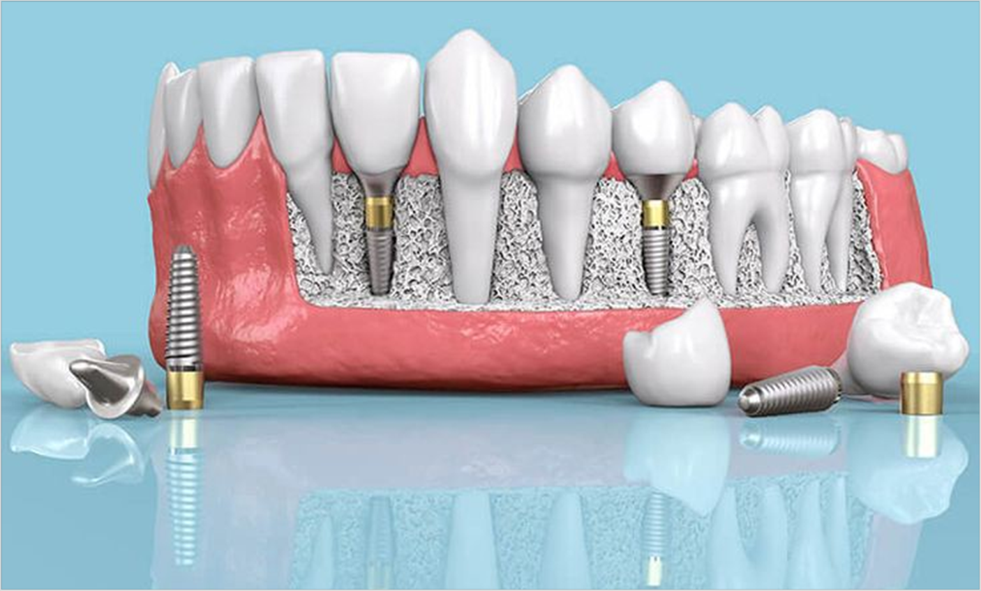 The most important advantages of dental implants