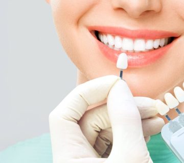 The difference between bleaching and dental laminate: which is more natural?