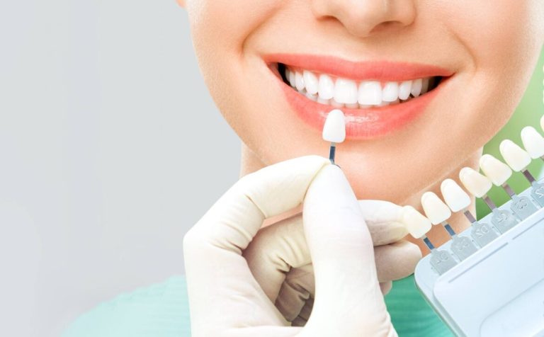 The difference between bleaching and dental laminate: which is more natural?
