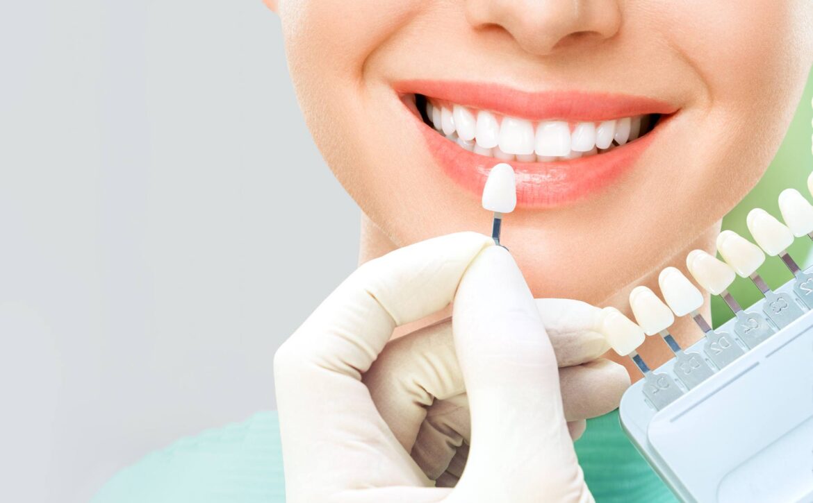 The difference between bleaching and dental laminate: which is more natural?