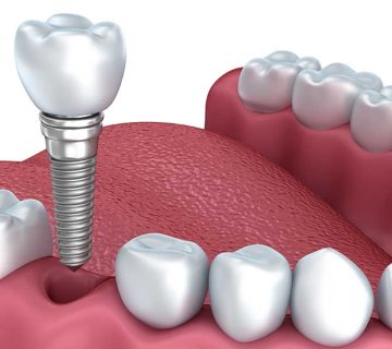 Do dental implants need to be replaced?