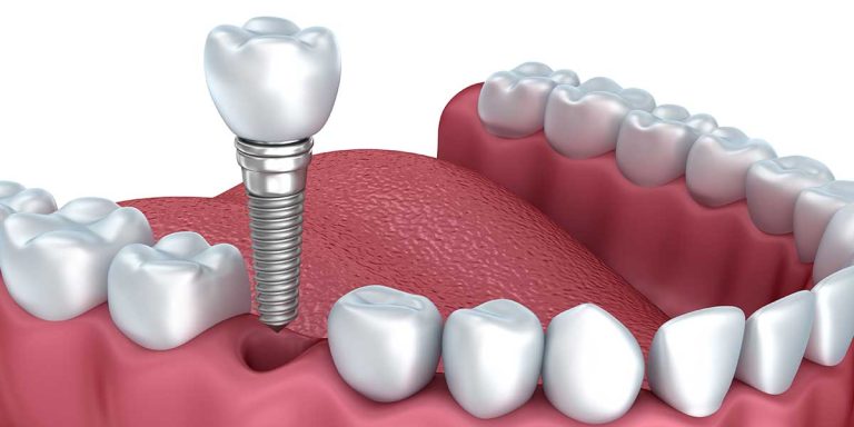 Do dental implants need to be replaced?