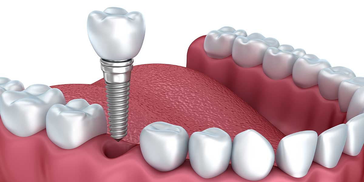 Do dental implants need to be replaced?