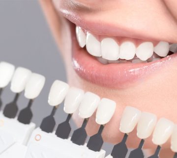 What are the stages of dental lamination?
