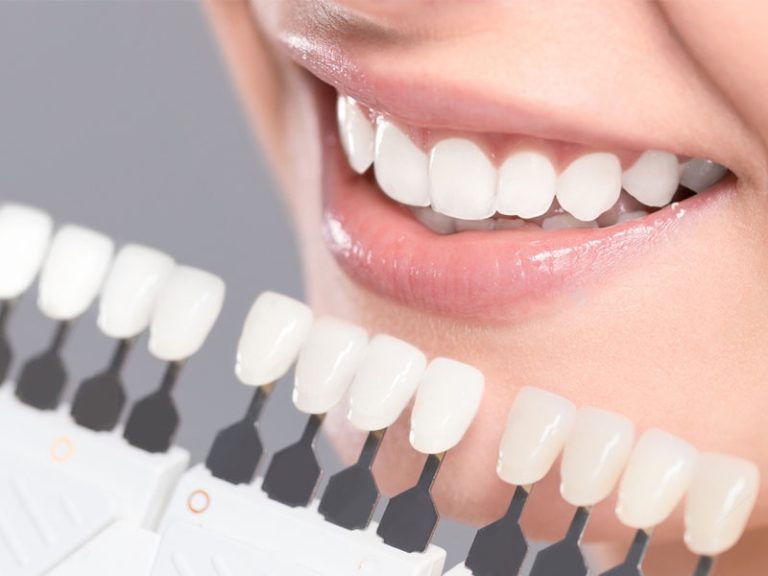 What are the stages of dental lamination?