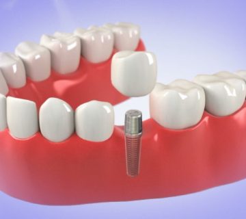 What are the disadvantages of dental implants?