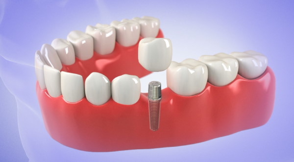 What are the disadvantages of dental implants?