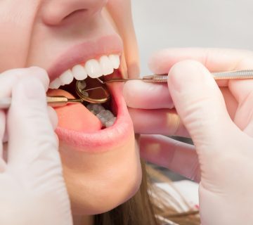 Does laminate cause tooth decay?