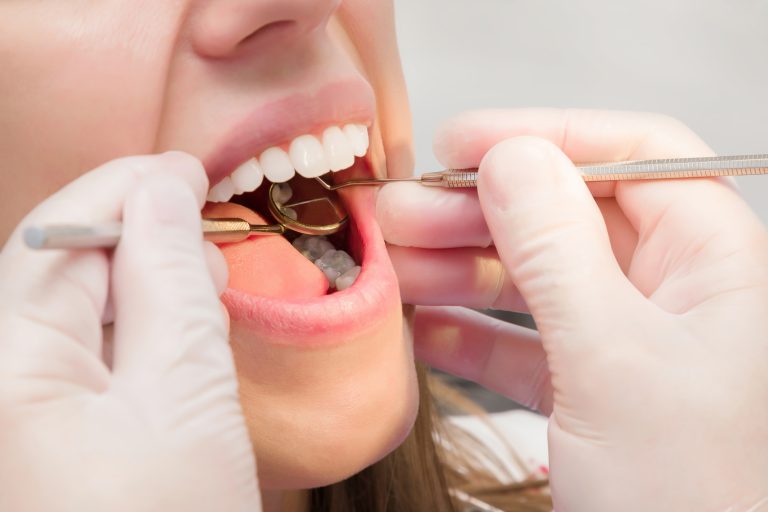 Does laminate cause tooth decay?