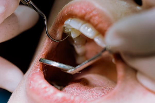 When do we need tooth extraction?