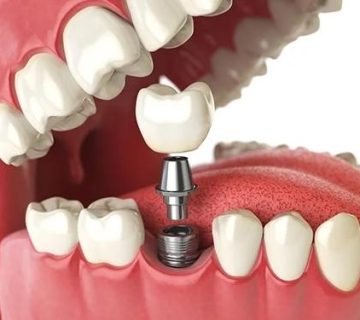 How long after tooth extraction should be implanted?