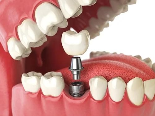 How long after tooth extraction should be implanted?