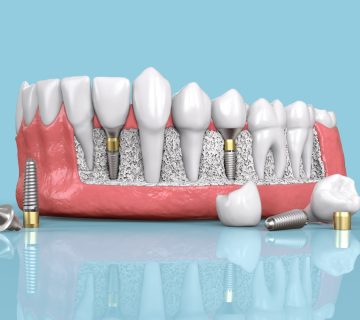 Three golden rules for successful implant placement