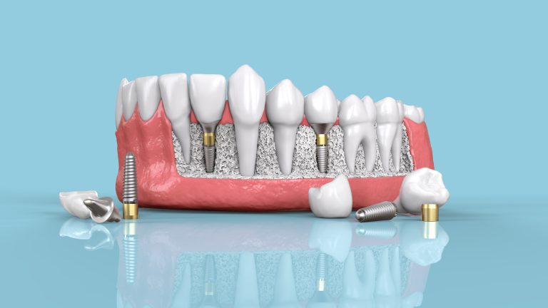 Three golden rules for successful implant placement