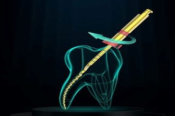 Using the new generation of rotary files for endo treatment