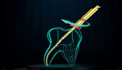 Using the new generation of rotary files for endo treatment