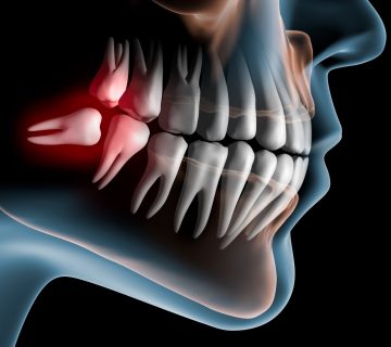 The best time to pull wisdom teeth?!