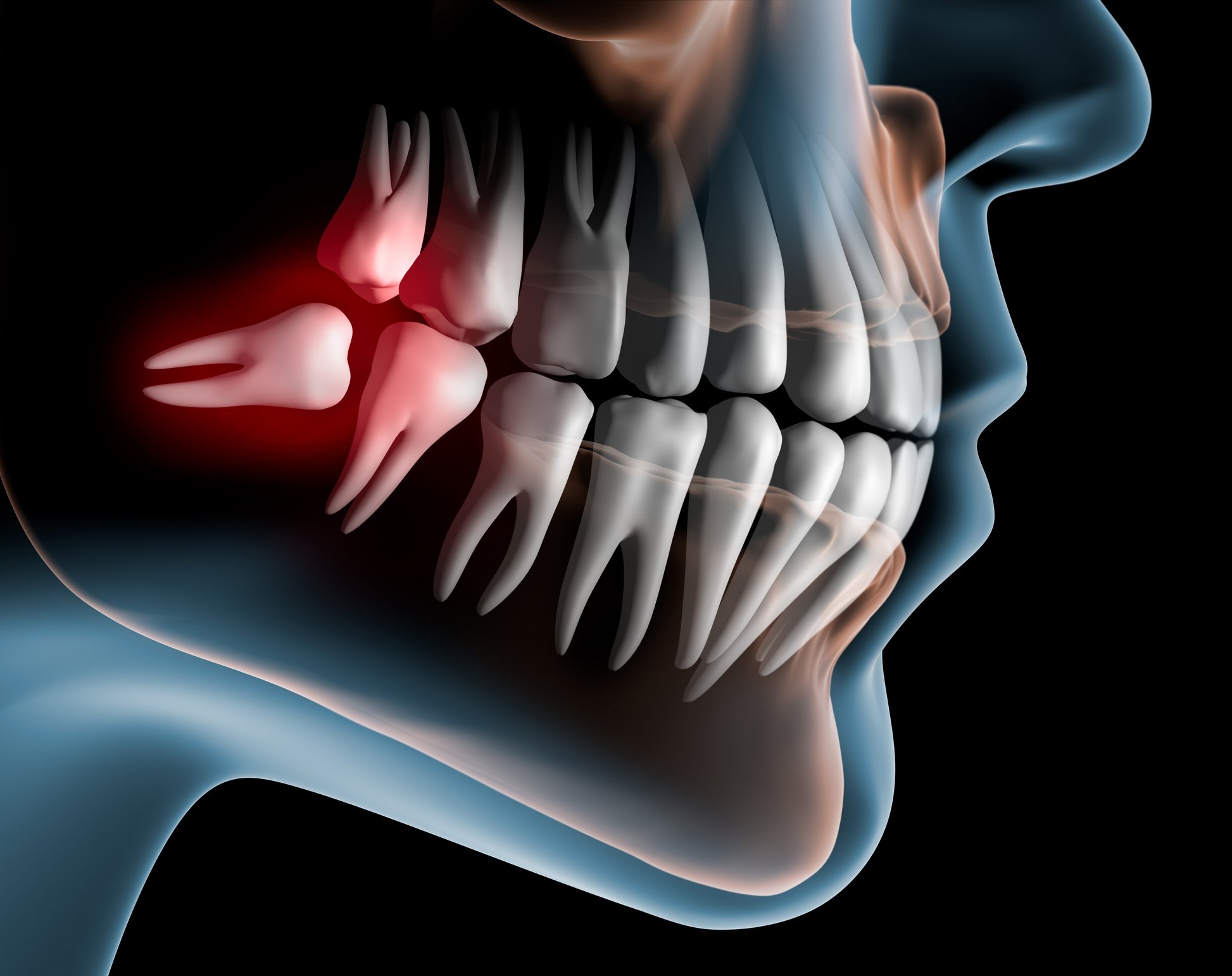 The best time to pull wisdom teeth?!