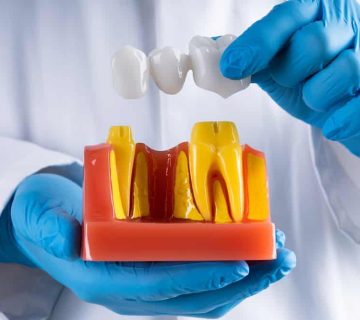The lifespan of a dental bridge