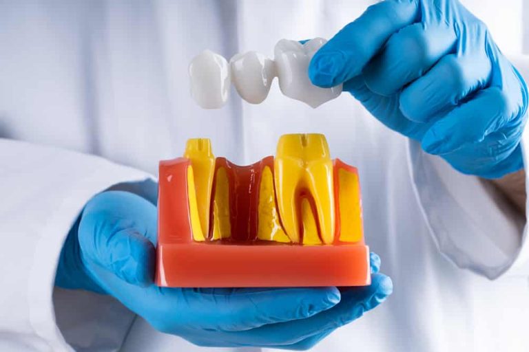 The lifespan of a dental bridge