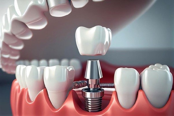 Implant molding