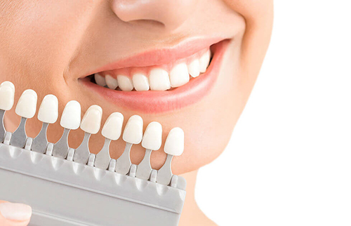 7 main reasons why we should laminate teeth