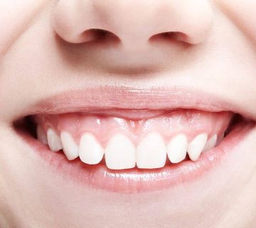 What is gum smile correction?
